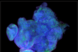 Esempio di tumore ottenuto riducendo i livelli di espressione di una proteina (fonte: Giacomo Cavalli)